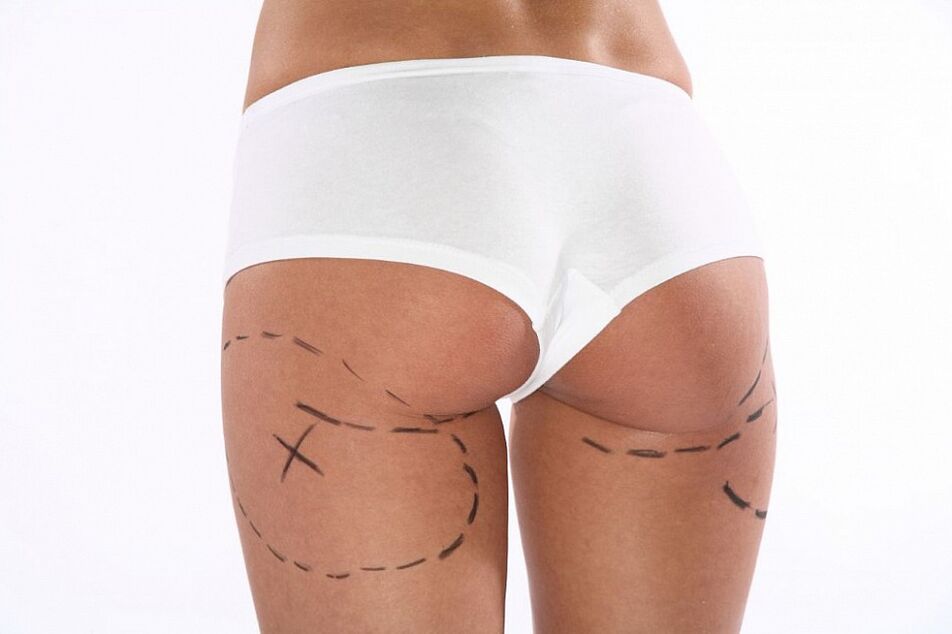 Weight Loss Cosmetic Surgery